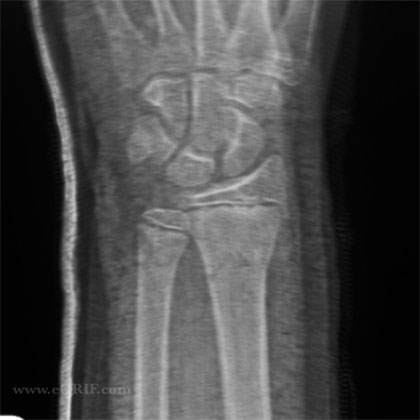 closed reduction xray pediatric distal radius fracture