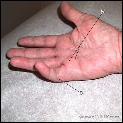 Dupuytren's Contracture Picture