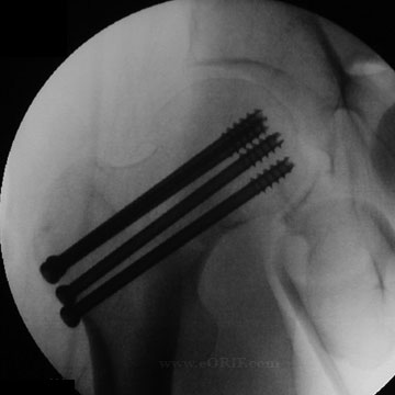 CRPP femoral neck fracture Cannulated screw fixation of femoral neck fracture