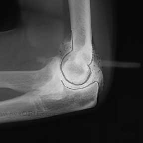 elbow arthritis xray elbow arthritis xray