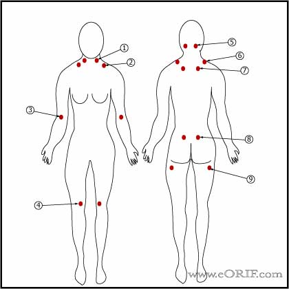 Fibromyalgia trigger points Fibromyalgia trigger point image
