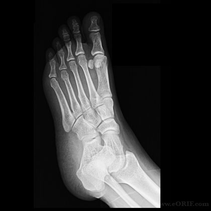 Foot oblique xray Foot oblique view xray