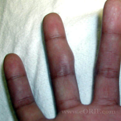 ganglion of the tendon sheath ganglion of the tendon sheath