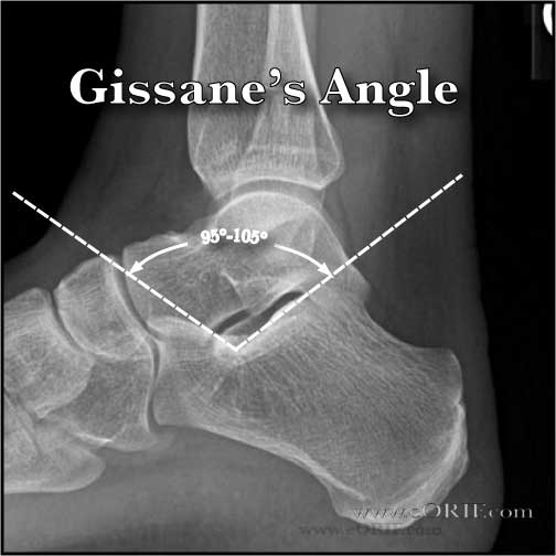 Gissane's Angle Gissane's Angle