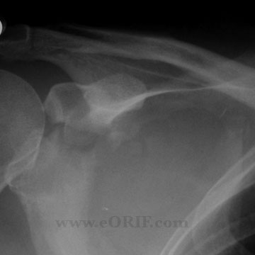 Glenoid fracture xray Glenoid fracture xray