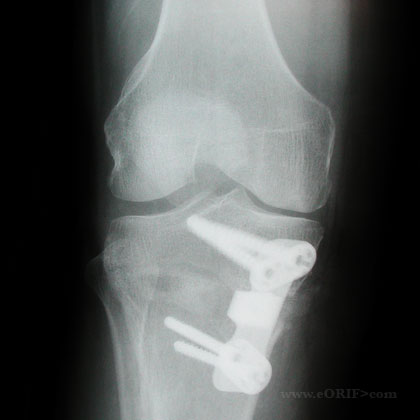 HTO xray HTO xray