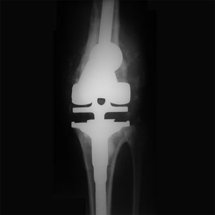 Periprosthetic knee infection xray Periprosthetic total knee injection xray