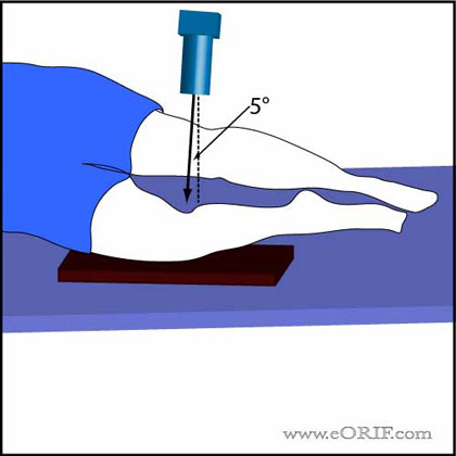 lateral knee xray technique lateral knee xray technique