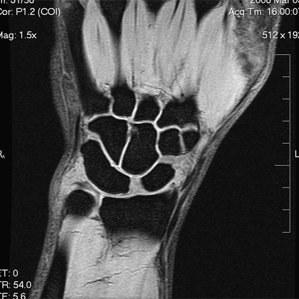 Lunotriquetral coalition MRI Lunotriquetral coalition MRI