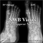 Lisfranc NWB xrays Lisfranc NWB xray