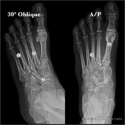 Lisfranc normal xray Lisfranc joint normal xrays
