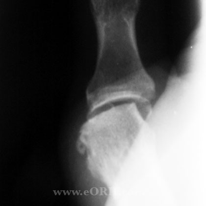 Thumb MCP osteoarthritis xray