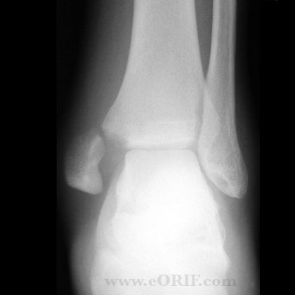 Medial malleolus fracture xray Medial malleolus fracture anterior view xray