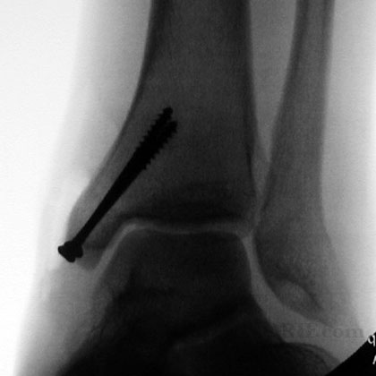 Medial malleolus fracture xray Medial malleolus fracture ORIF xray