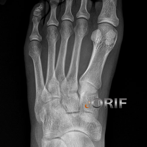 Metatarsal stress fracture Metatarsal stress fracture