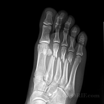 Metatarsal fracture xray Metatarsal fracture Oblique xray