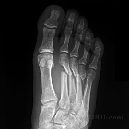 Metatarsal fracture xray Metatarsal fracture A/P view xray