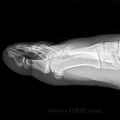 Metatarsal fracture lateral xray Metatarsal fracture lateral view xray