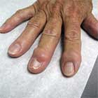 Mucous cyst photo Mucous cyst clinical photo