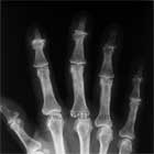 Mucous cyst xray Mucous cyst xray