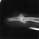 Mucous cyst lateral xray Mucous cyst lateral view xay