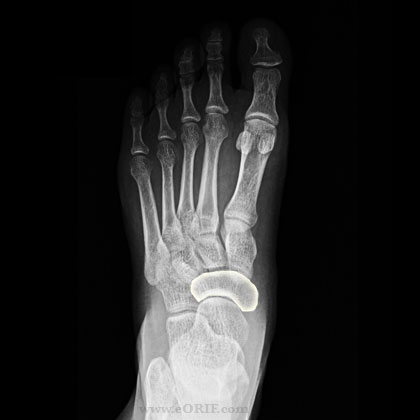navicular xray navicular foot bone xray