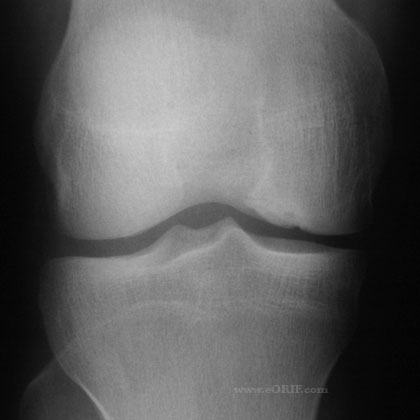 knee osteochondritis dissecans xray knee ocd xray