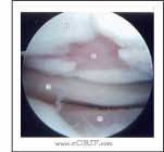 Chondral injury picture Grade IV chondral injury image
