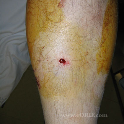Open tibial shaft fracture pic Open tibial shaft fracture image