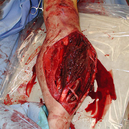 Grade 3 open tibial shaft fracture pic Grade 3 open tibial shaft fracture image