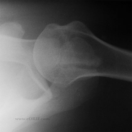 Os acromionale xray Os acromionale xray