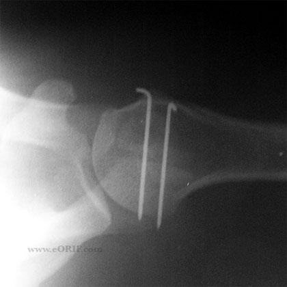 Os Acromionale ORIF xray Os Acromionale ORIF xray