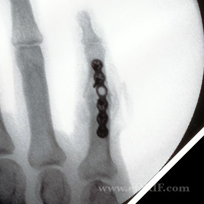 PIP arthrodesis PIP arthrodesis xray