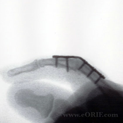 PIP arthrodesis xray PIP arthrodesis lateral view