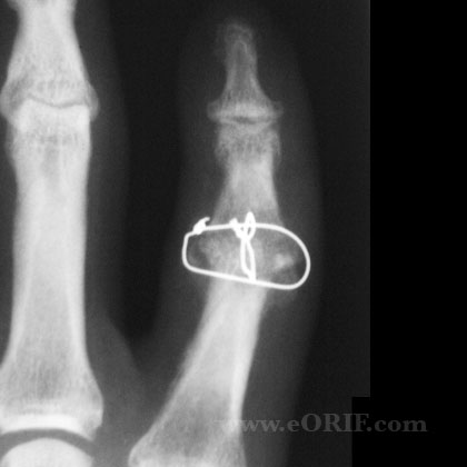 PIP fusion PIP fusion xray