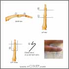 PIP external fixation PIP joint external fixation