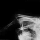 PIP joint dislocation PIP joint dislocation xray
