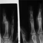 PIP dislocation xray PIP joint dislocation xray