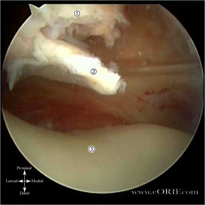 patellar dislocation image patellar dislocation picture