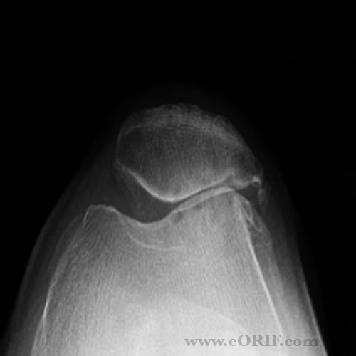 Patellofemoral arthritis xray Patellofemoral arthritis xray