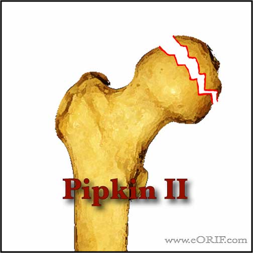 Pipkin Type II femoral head fracture image