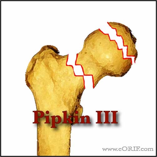 Pipkin Type III femoral head fracture image
