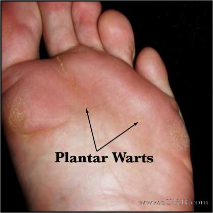 Plantar wart Plantar wart clinical photo