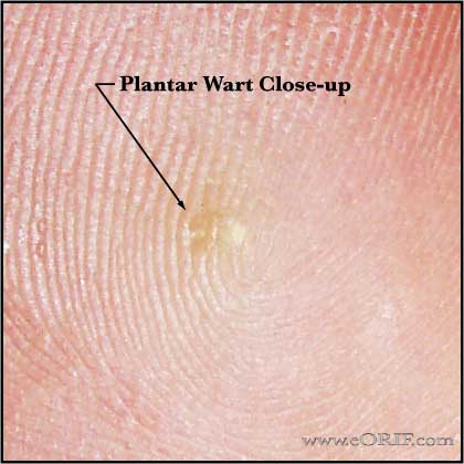 Plantar wart image Plantar wart clinical photo