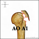AO A1 proximal humerus fracture