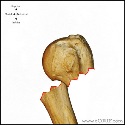 Type A3 proximal humerus fracture