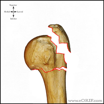Type B1 proximal humerus fracture