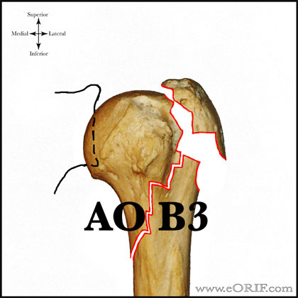 Type B3 proximal humerus fracture