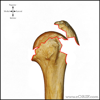 Type C2 proximal humerus fracture