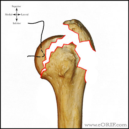 Type C3 proximal humerus fracture